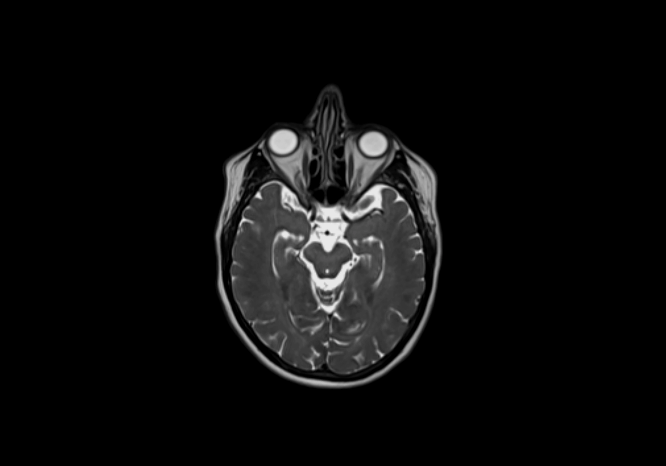 Neck axial  lymph node cross sectional MRI anatomy 3T MRI  image-img-00001-00004.webp